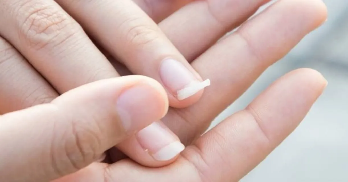 Thin, Weak, Brittle Nail: Causes & How to Care for Them